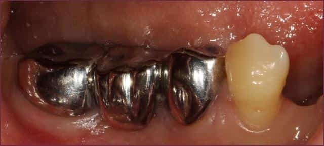 Металл для зубных коронок 6 букв