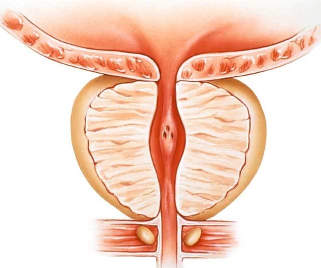 Гистология предстательной железы после операции на предстательной железе
