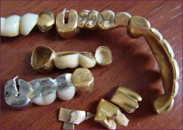 Металл для зубных коронок 6 букв