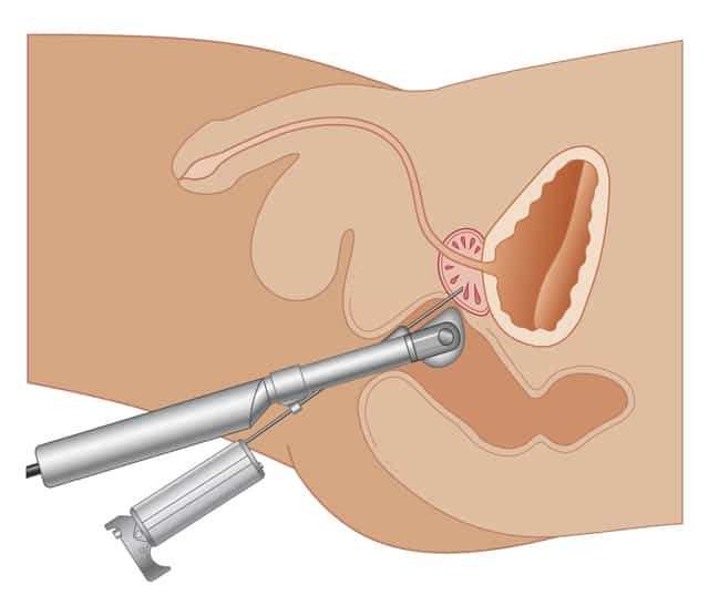 Гистология предстательной железы после операции на предстательной железе